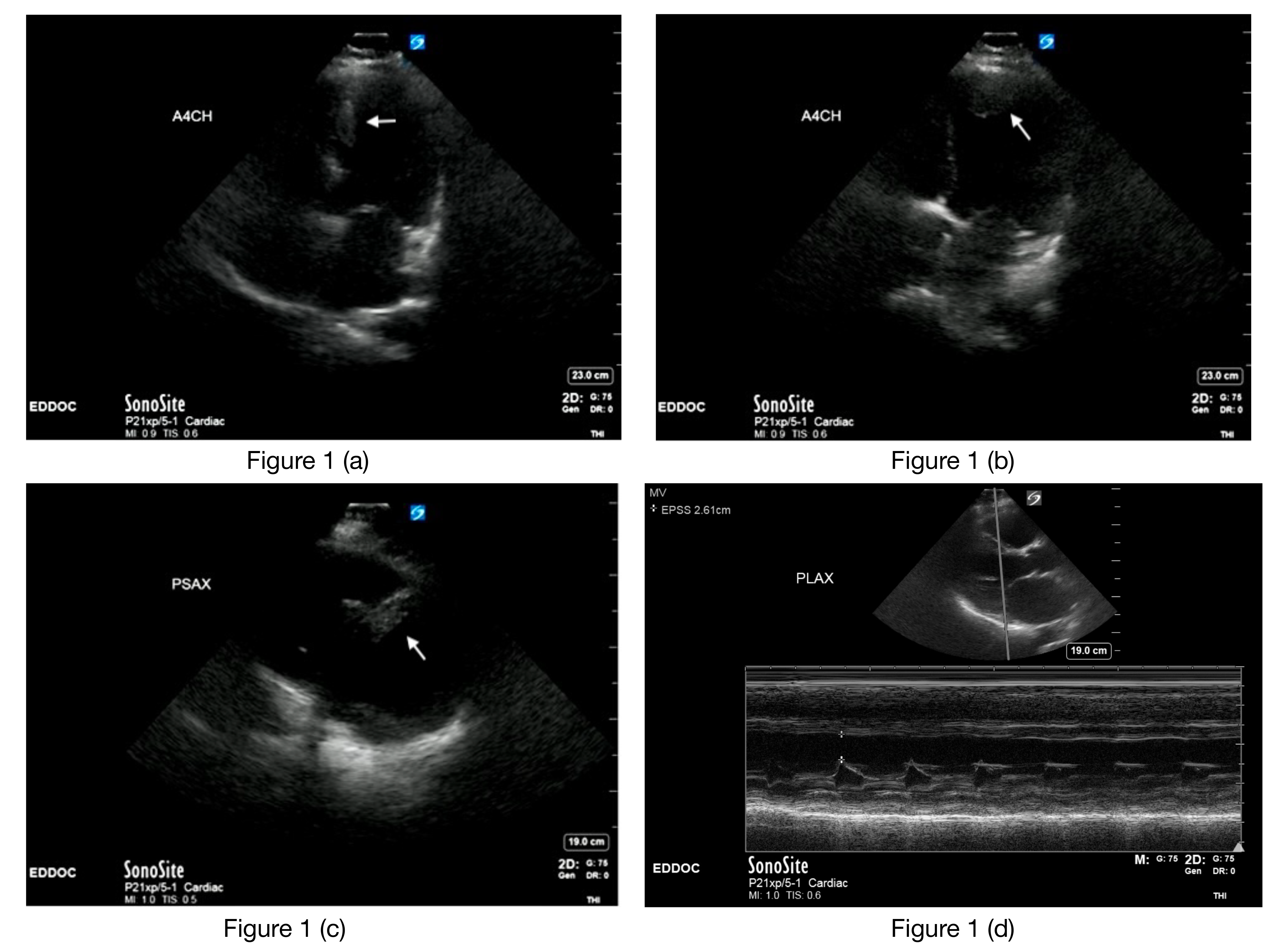 Left Ventricular Thrombus In A Patient With Shortness Of Breath 