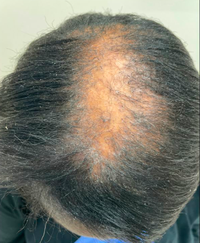 Central Centrifugal Cicatricial Alopecia Coexisting with Traction ...