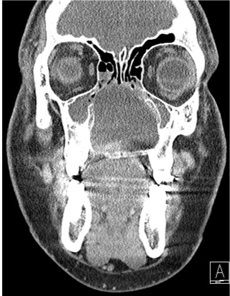 A Case of a Giant Nasopalatine Duct Cyst | Published in Journal of the ...